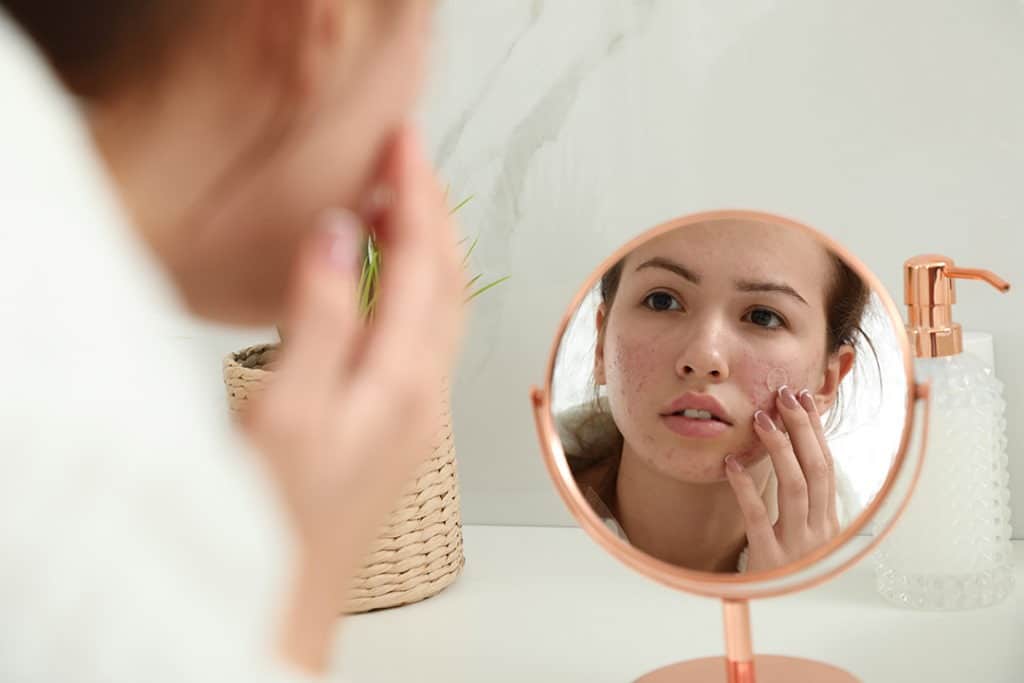 Will My Acne Scars Ever Go Away? - Up On Beauty