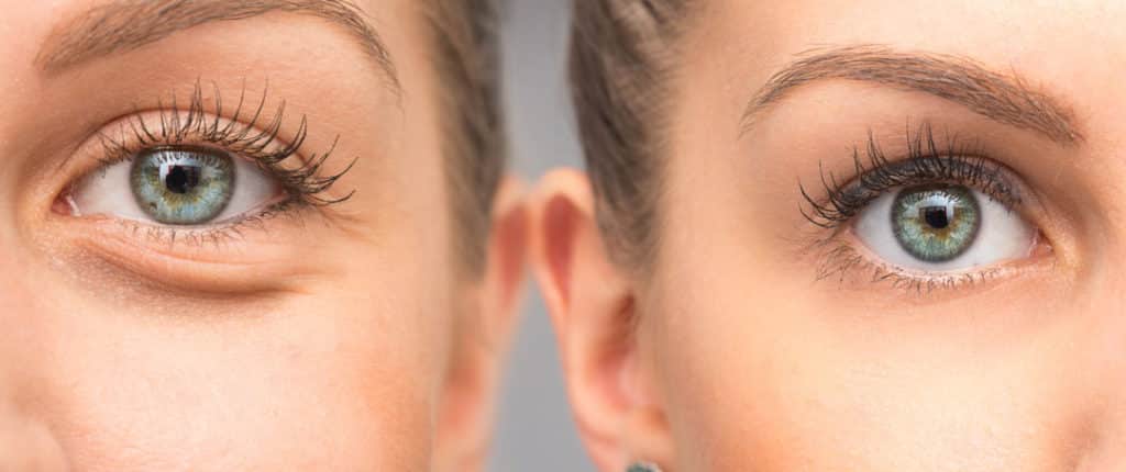 26 Ways to remove dark circles and under eyes bags