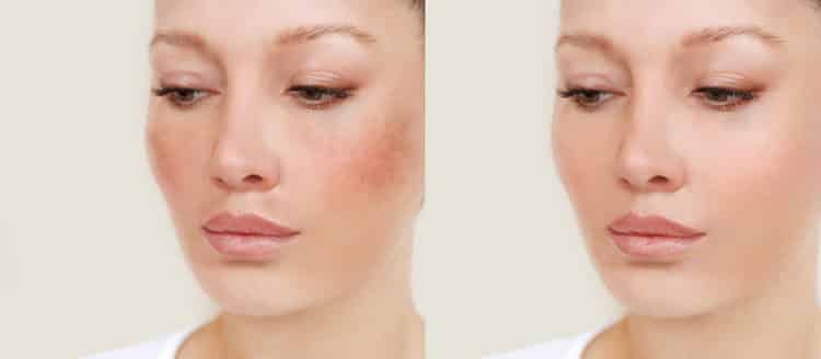 Best Skin Lightening Cream for Hyperpigmentation